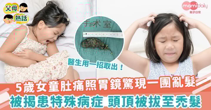 【怪癖】5歲女童肚痛照胃鏡驚現一團亂髮　被揭患特殊病症 頭頂被拔至禿髮