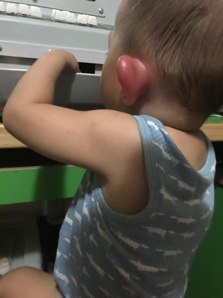 不少網民都對紅腫的程度感到不可置信。