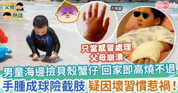 【細菌感染】男童海邊撿貝殼摸螃蟹回家後高燒不退 手腫成球險截肢 疑因壞習慣惹禍