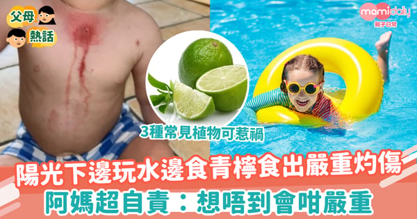 【瑪格麗特灼傷】陽光下邊玩水邊食青檸食出嚴重灼傷 阿媽自責:想唔到會咁嚴重