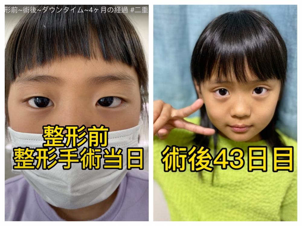 母女兩人對雙眼皮的結果非常滿意。