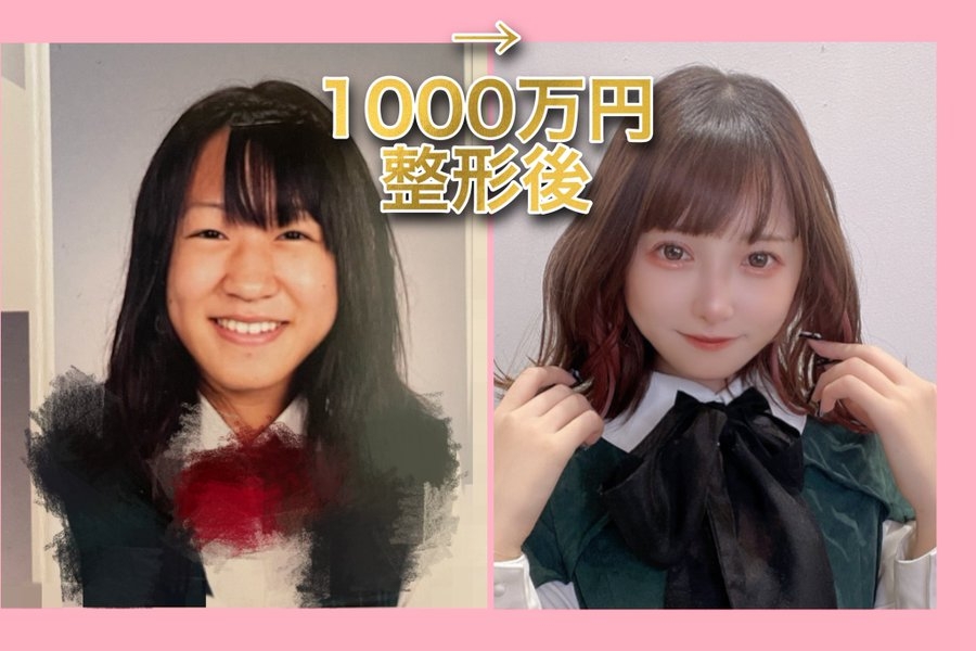 網紅至今共注資1千萬日圓（約港幣55萬元）到整容手術上。