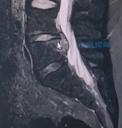 經檢查後出現尾椎骨斷裂，需要住院一星期