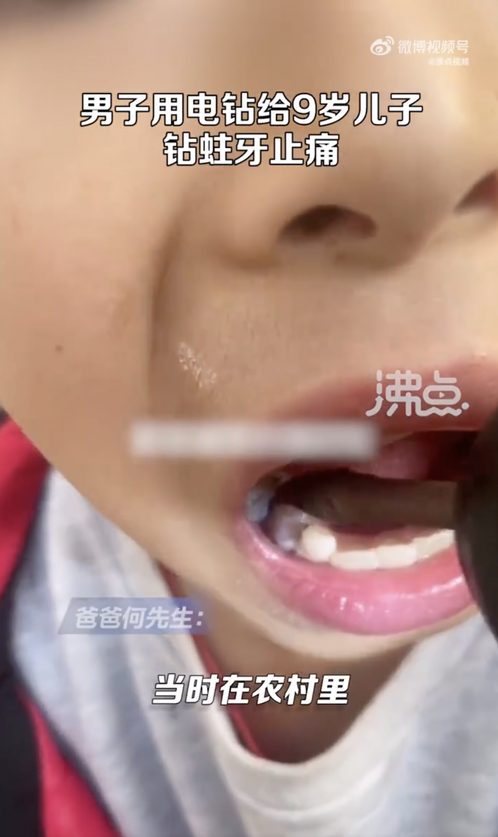 何先生用電鑽幫兒子鑽蛀牙止痛。