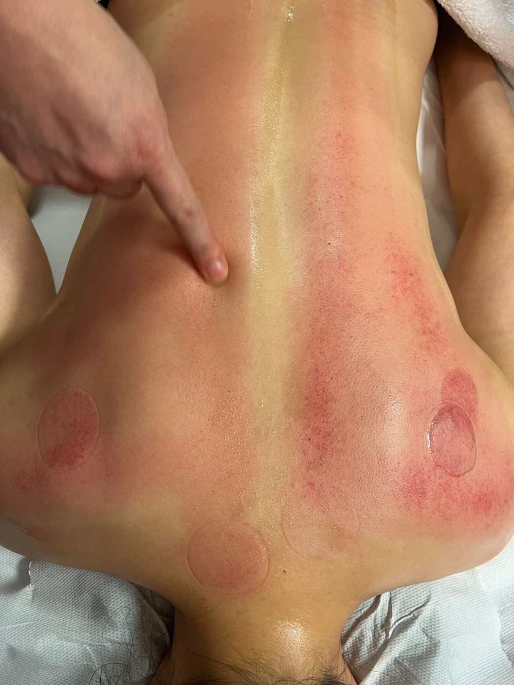 在同學身上學習走罐，留下長長紅痕