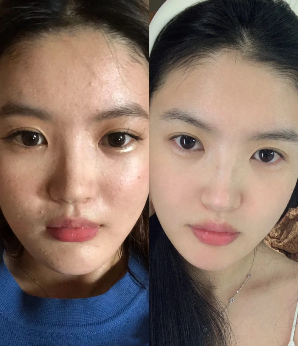 控糖後亦改善皮膚問題