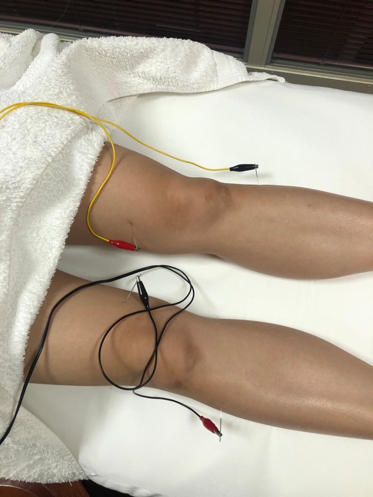 幫病人進行電針