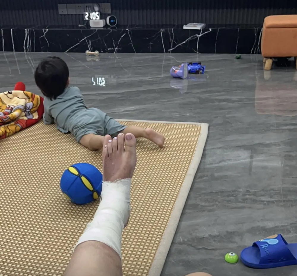 媽媽的手腳嚴重燒傷。