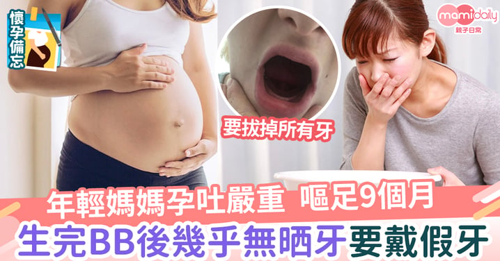 【懷孕】年輕媽媽孕吐嚴重 嘔足9個月 生完BB後幾乎無晒牙 戴假牙生活