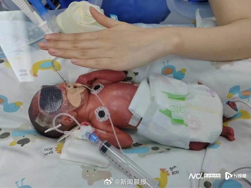 醫生建議讓胎內另一個寶寶在子宮內爭取更多存活可能。