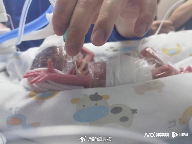 這對當地孕週最小、體重最輕的龍鳳胎姐弟出生時幾乎只有巴掌大。