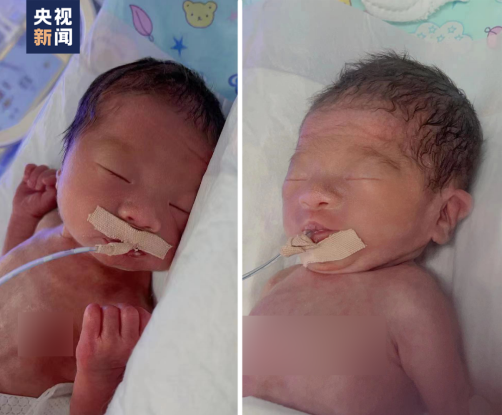 雙百態姐妹情況良好，已經不用吸氧，還擁有「定海」和「神針」的乳名。