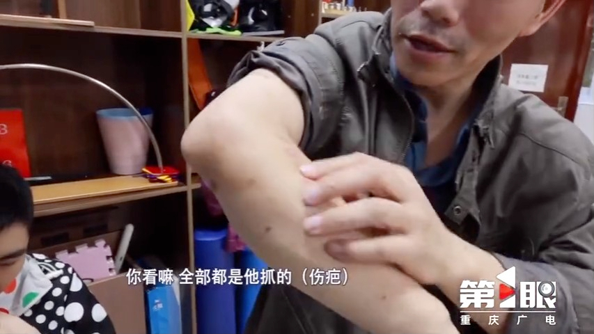 易和平指，兒子有時候會抓傷自己。