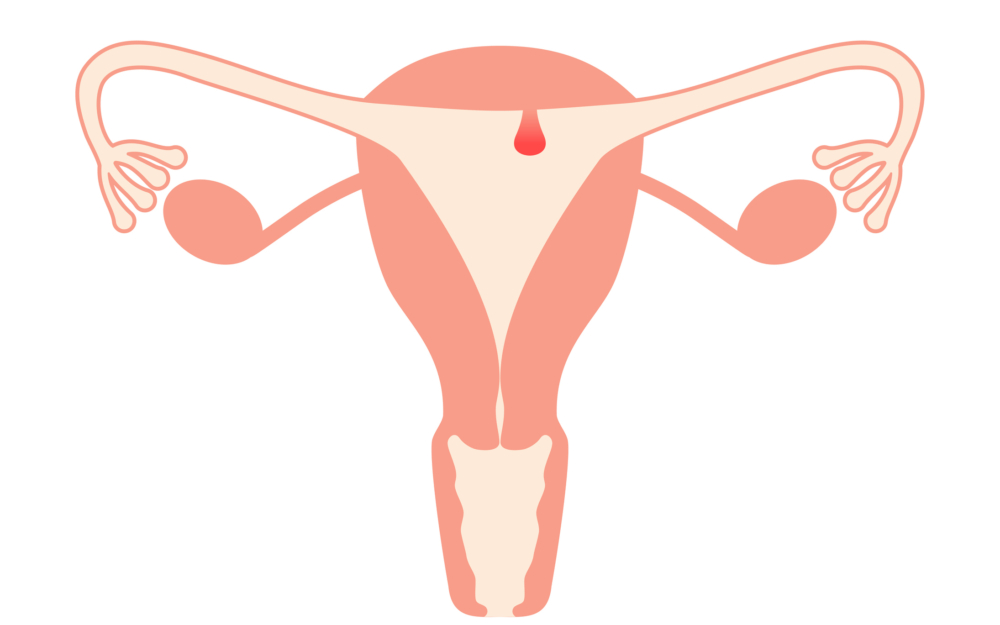 子宮內膜瘜肉多屬良性