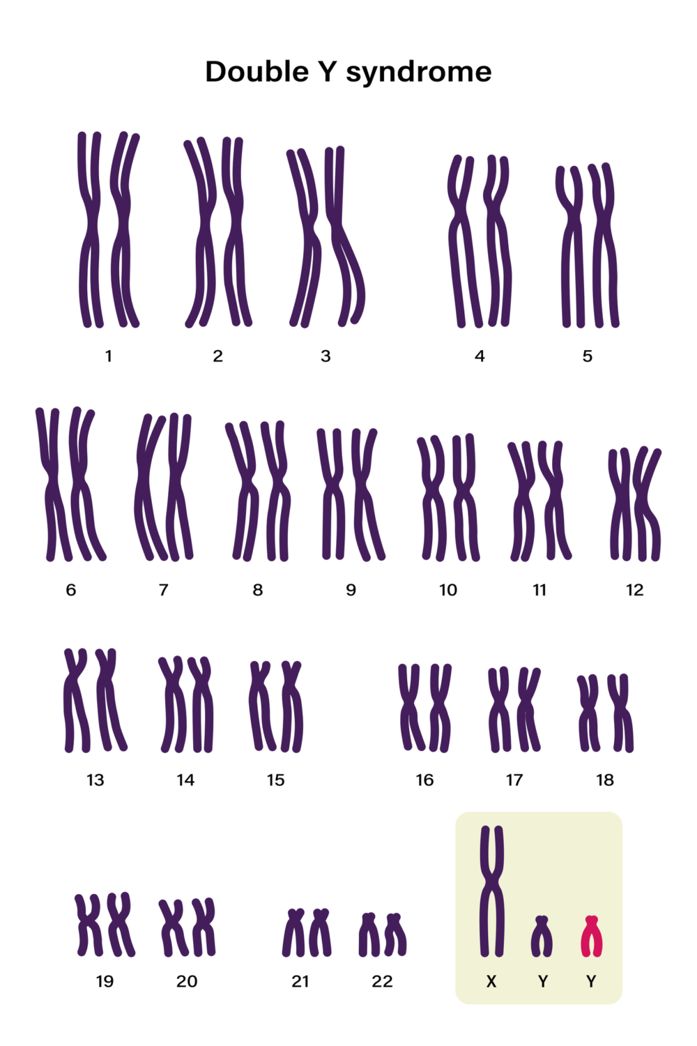 超雄綜合症（XYY syndrome）是一種性染色體異常，患者的性染色體組合為XYY