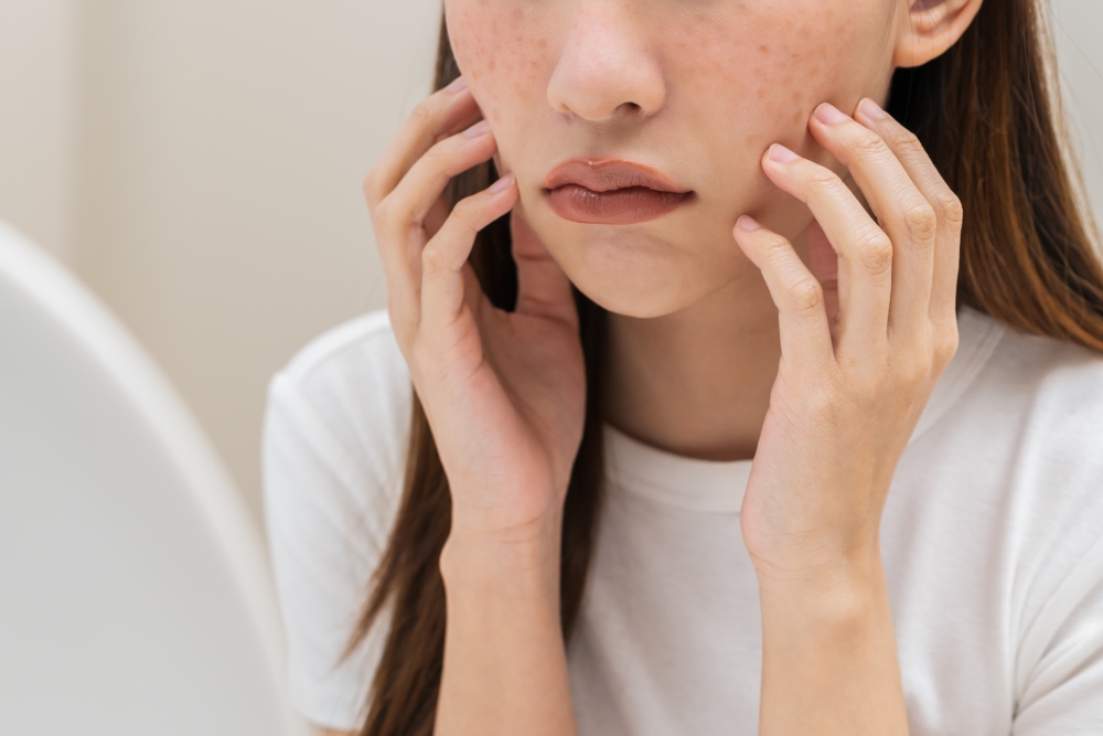 色斑並非只有單一類型，其形成原因、外觀、深淺各不同，而且根據黑色素分佈的深淺，分為「淺層色斑」和「深層色斑」。