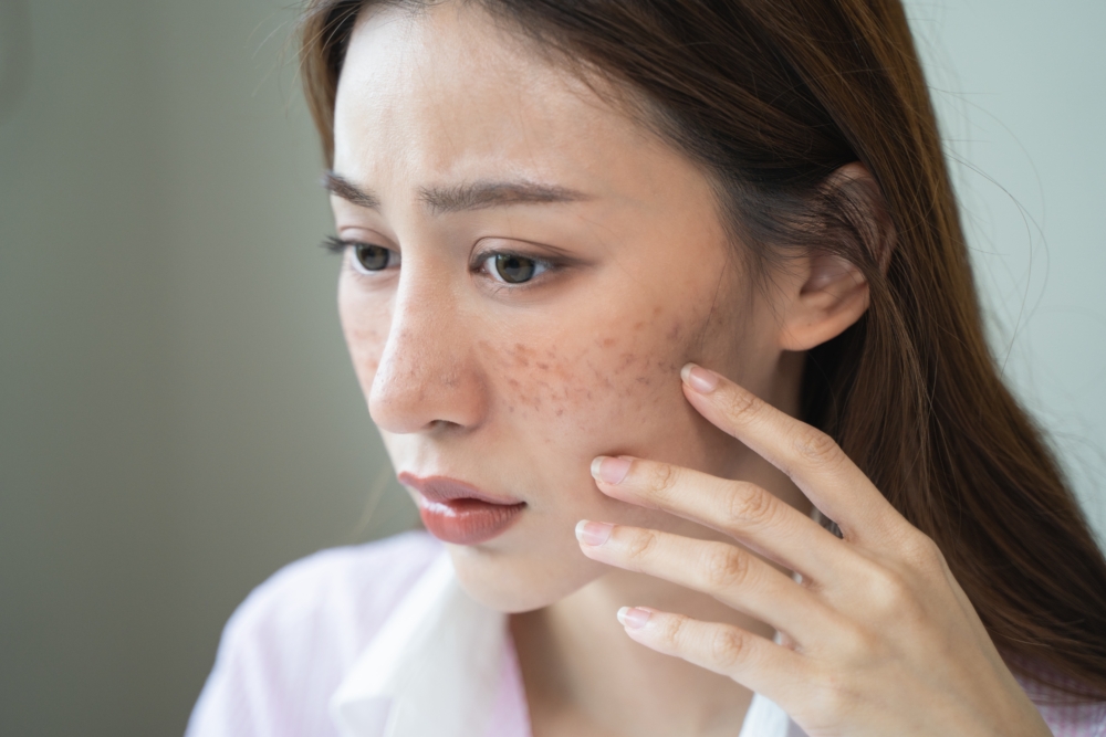 色斑源於皮膚底層的「黑色素細胞」,它們製造黑色素以保護皮膚免受紫外線傷害,但是當黑色素生成過多或代謝不暢,色素便會沉澱,形成深淺不一的斑點。