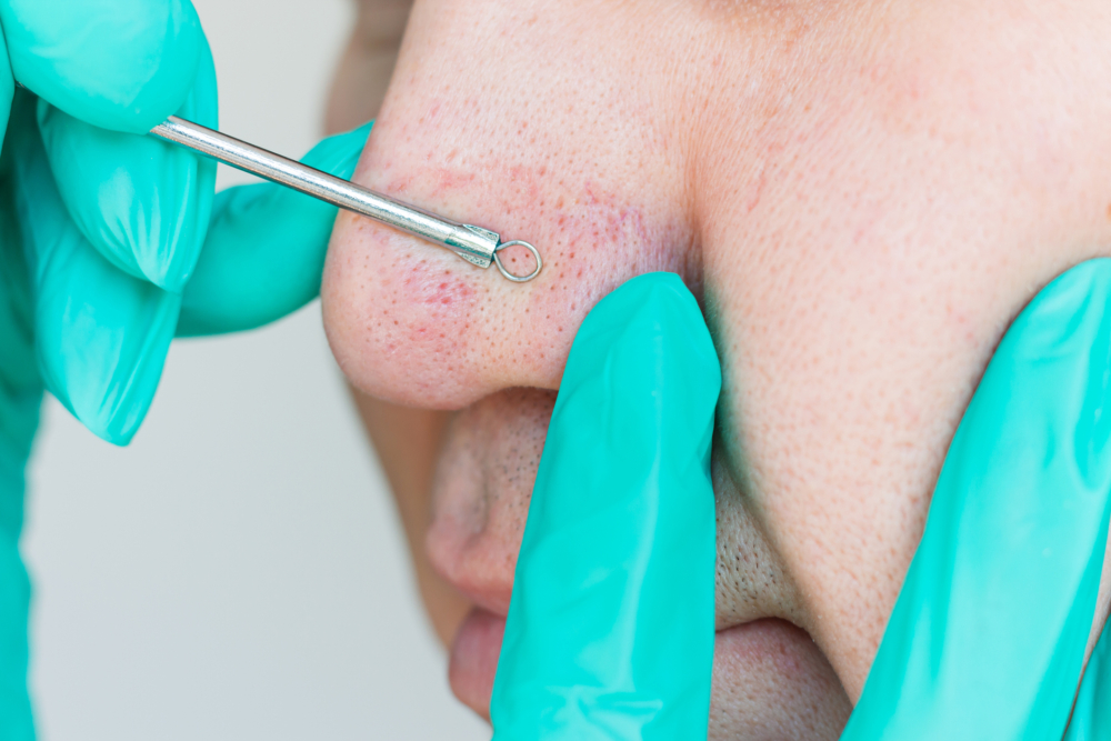 清除黑頭粉刺方法:手動擠壓。