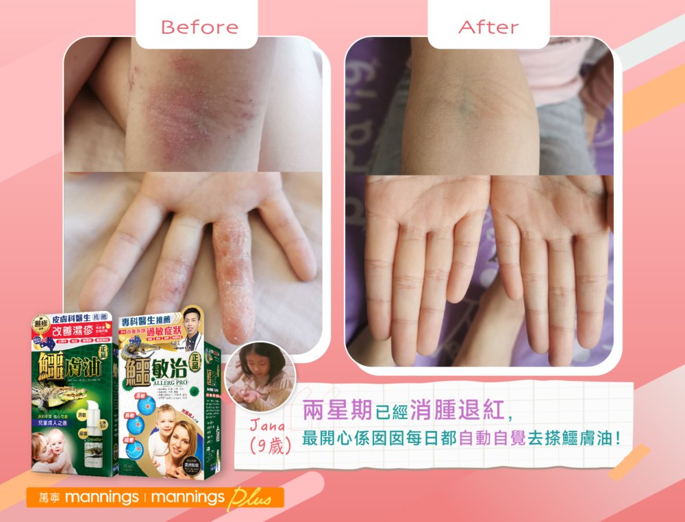 Jana（9歲）用了『正品鱷膚油』兩個禮拜，傷口已經消腫退紅。
