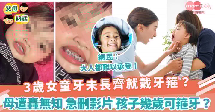 【兒童箍牙】3歲女童牙未長齊就戴牙箍？　母遭轟無知 急刪影片 孩子幾歲可箍牙？
