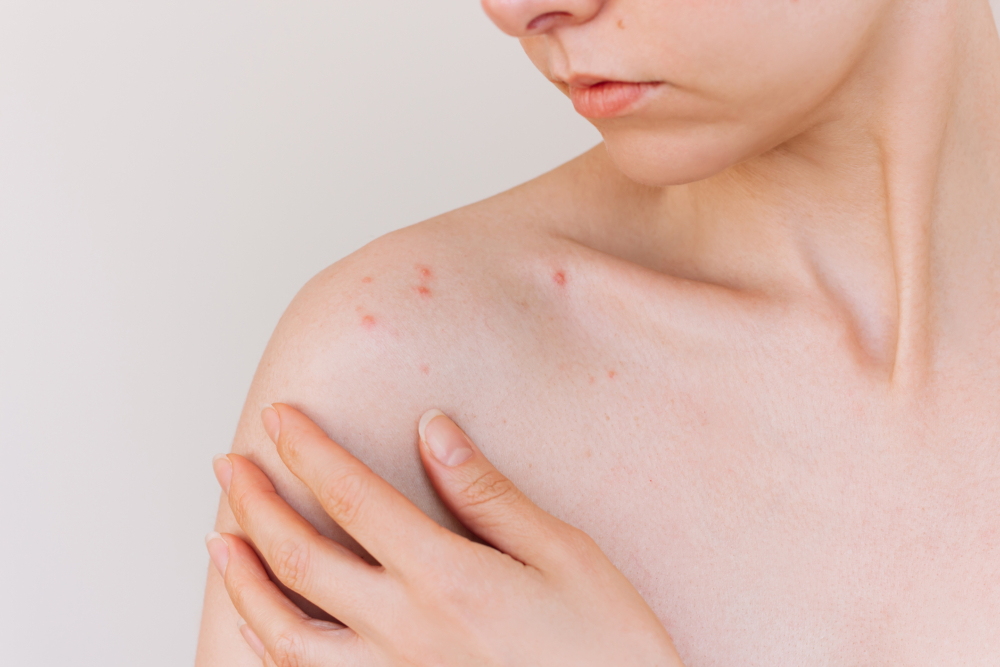 身體突然長痘痘可能與環境、壓力或荷爾蒙改變有關。