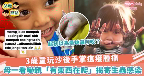 【皮膚感染】3歲童玩沙後手掌痕癢腫痛 母一看嚇親「有東西在爬」揭寄生蟲感染