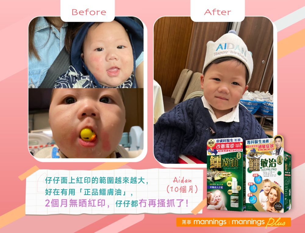 Aidan（10個月）用了2個月，紅印完全消失，也沒有再亂抓。