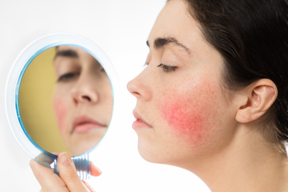 玫瑰痤瘡(Rosacea),俗稱「酒糟鼻」,是一種以面部持續泛紅和反覆出現紅斑丘疹為特徵的慢性炎症性皮膚病。