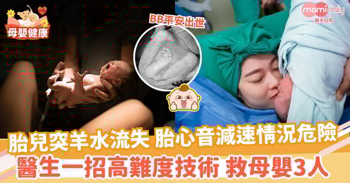 【分娩】胎兒突沒羊水 胎心音減速情況危險 醫生一招高難度技術 救母嬰3人