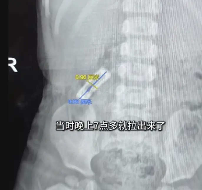 女童順利將髮夾排出體外，無需手術介入，全程安全且無任何併發症，也避免了麻醉和手術風險