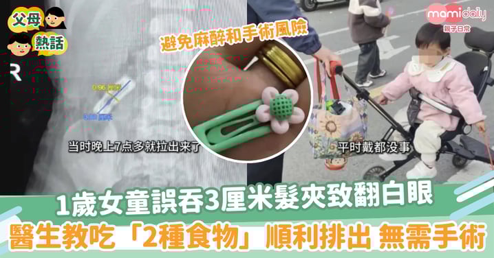 【誤吞髮夾】1歲女童誤吞3厘米髮夾致翻白眼 醫生教吃「2種食物」順利排出 無需手術