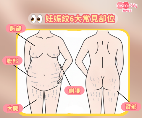 妊娠紋6大常見部位