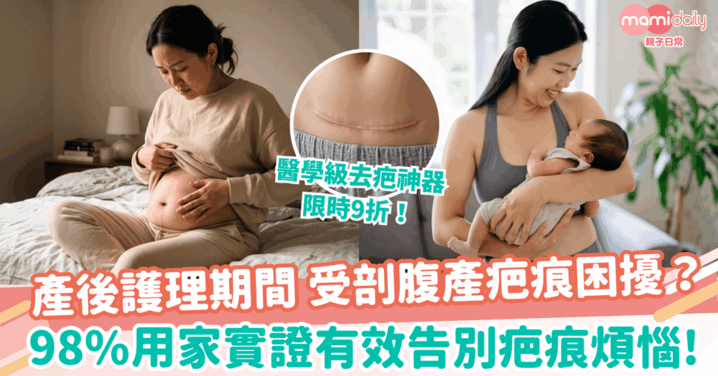 【產後護理】受剖腹產疤痕困擾？醫學級去疤神器限時9折 一招重拾平滑肌