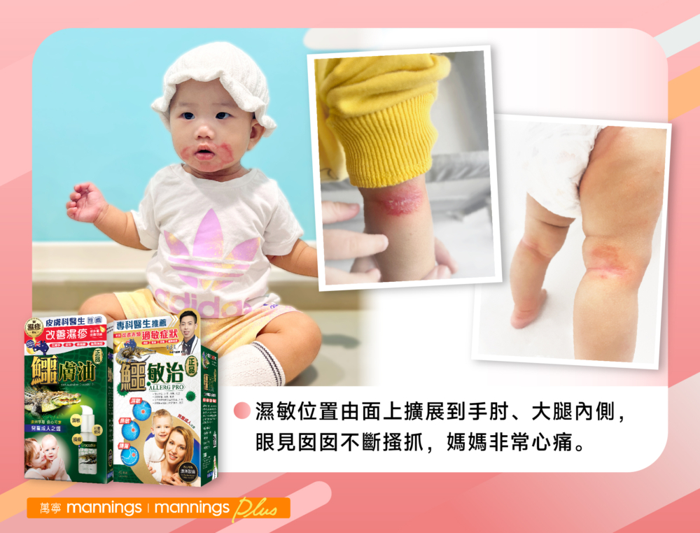 半歲大的Xanthe，是Candy媽媽的心肝寶貝，也曾是濕敏的「受害者」。