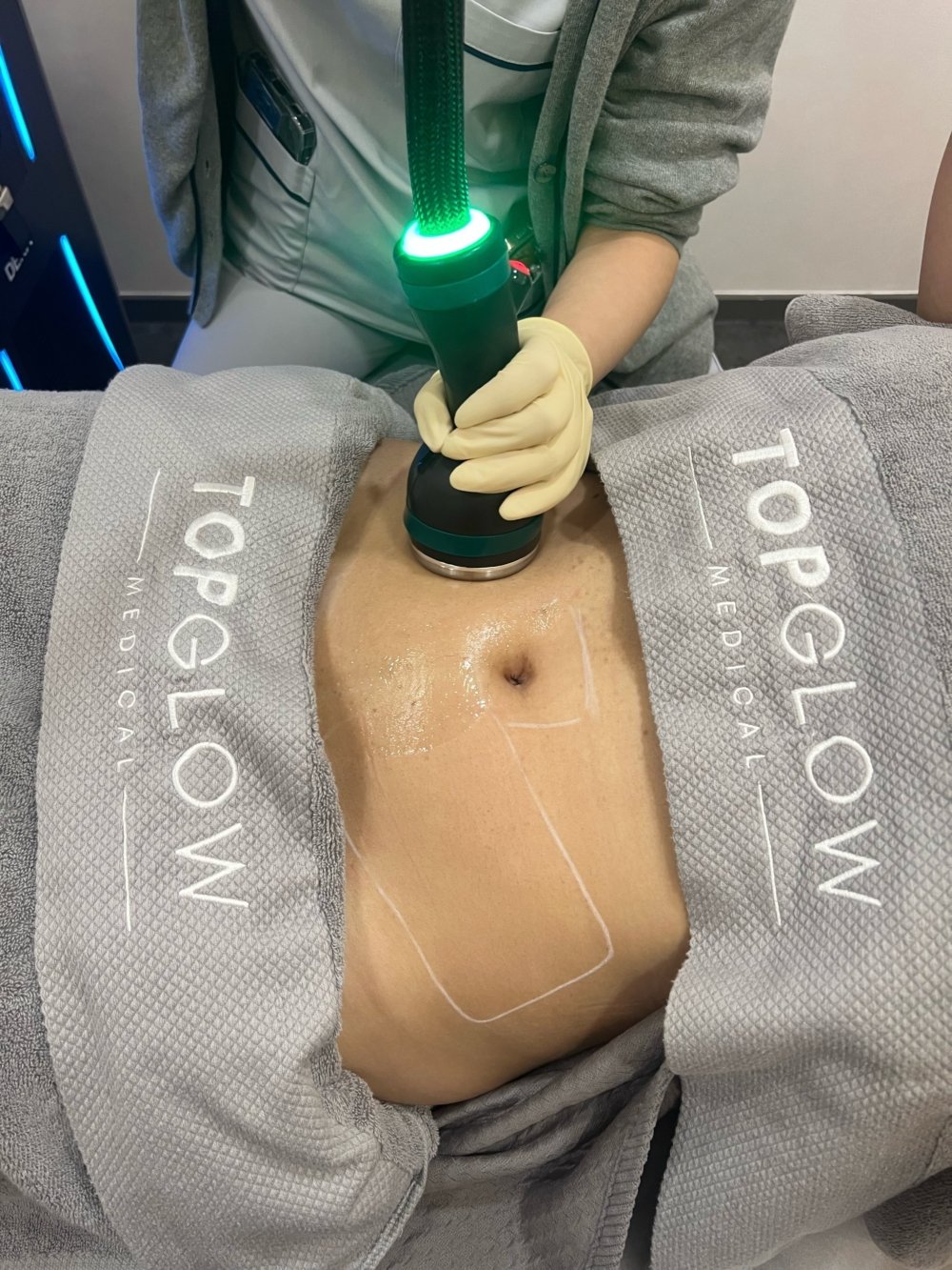 女客人正在TopGlow Medical接受TotalSculpt™ 全效塑形療程。