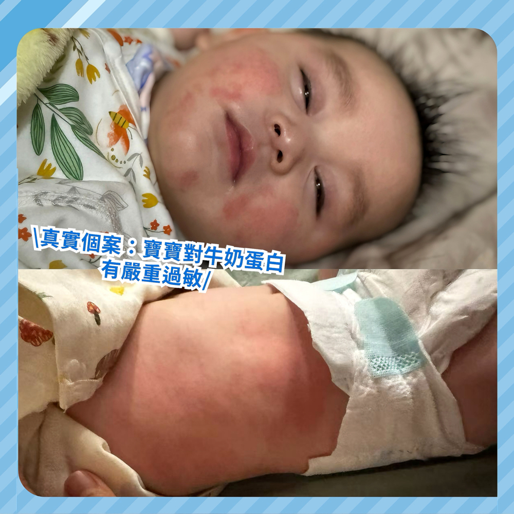 仔仔玥辰在6個月大停止母乳餵哺並轉喝牛奶後，濕疹問題突然爆發。經醫生診斷，才發現仔仔對牛奶蛋白有嚴重過敏。